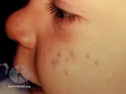 Infantile acne