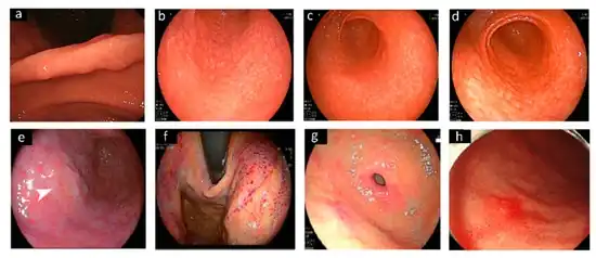 Different endoscopic patterns related to H. pylori infection.