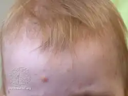 Juvenile xanthogranuloma