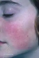 Keratosis pilaris face