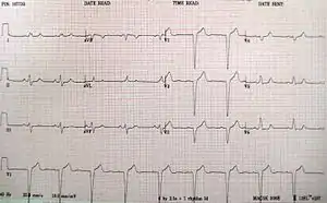 A left bundle branch block