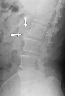X-ray showing osteophytes of spondylosis of the lumbar spine