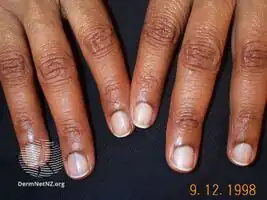 Laugier-Hunziker syndrome