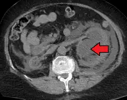 Left sided hydronephrosis in a person with an atrophic right kidney. Stent is also present (image below).