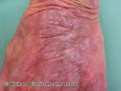 Lichenoid drug eruption