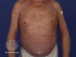 Lichenoid drug eruption