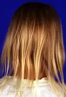 Loose anagen syndrome