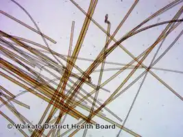 Loose anagen syndrome