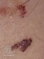 Lymphangioma circumscriptum