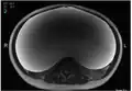 MRI giant serous cystadenoma ovary