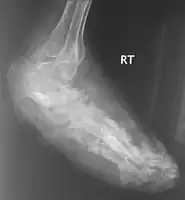 X-ray foot: mycetoma