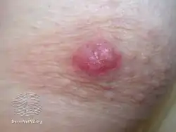 Mammary Paget disease of the skin