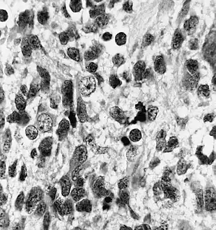 Neuronal differentiation, ranging from neuroblasts to ganglion cells, is seen in some medulloepitheliomas.