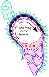 Immune complexes (black) are deposited in a thickened basement membrane creating a "spike and dome" appearance on electron microscopy.