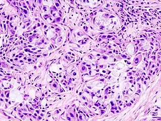 Histopathologic image of mucoepidermoid carcinoma of the major salivary gland. The same lesion as shown in a filename "Mucoepidermoid carcinoma (2) HE stain.jpg". H & E stain