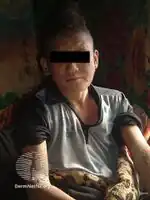 Multicentric reticulohistiocytosis