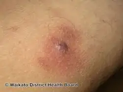 Mycobacterium chelonae