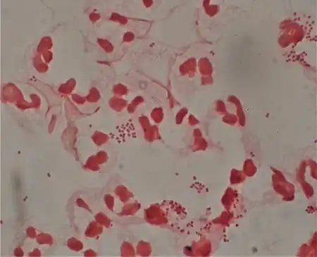 Neisseria gonorrhoeae and pus cells from a penile discharge (Gram stain)