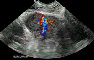 Ultrasound: early pregnancy