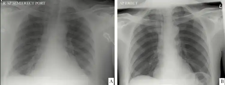 a)Chest x-ray  from individual at time of CoV-HKU1 diagnosis b) chest x-ray  1-year before