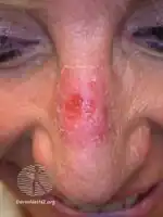 One week after MAL PDT