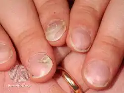 Onychomadesis following hand foot and mouth disease