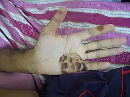 Osler lesions found on the hand and fingers of a 43-year-old male with subacute bacterial endocarditis