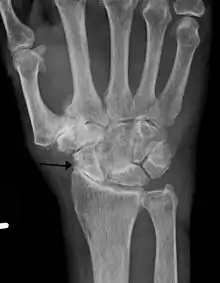 Severe osteoarthritis and osteopenia of the carpal joint and 1st carpometacarpal joint.