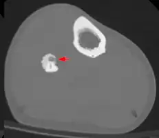 2. CT scan showing an osteoid osteoma of the fibula with a clearly visible nidus