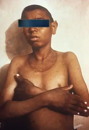 This child has the skin rash associated with pellagra