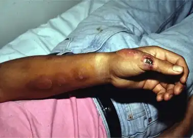 Lymphocutaneous sporotrichosis