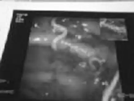 Whipworm  ( multiple ulcers and blood clots in the ileum.)