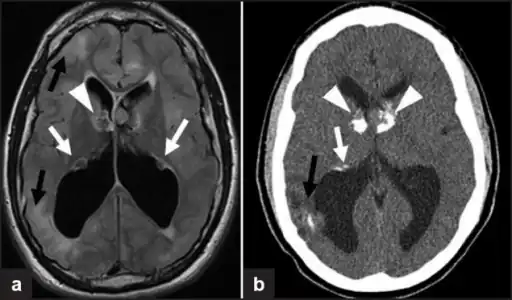 a,b)Images of subependymal giant cell astrocytomas arrowheads