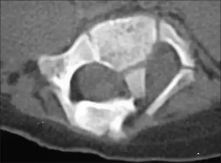 Computerized tomography - shows diastematomyelia with a large intraspinal bony bar at L2–L3 vertebral level
