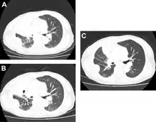 Docetaxel for non-small-cell lung cancer a) before b) tumor response after two cycles c) after 4 cycles