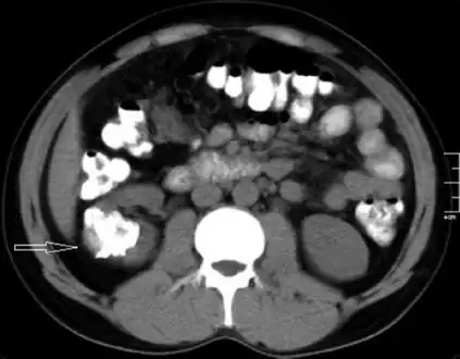 Left flank pain and gross hematuria diagnosed with renal medullary fibroma