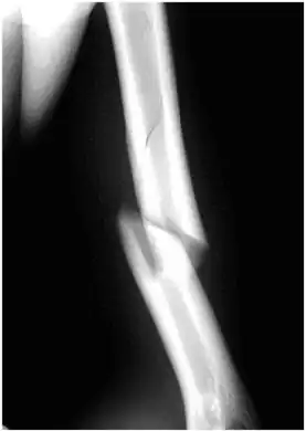 Internal rotation view showing a spiral fracture at junction of  middle and distal thirds of humerus.