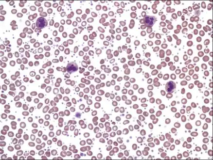 Thrombocytosis without obvious morphologic abnormalities of  white blood cells and erythrocytes