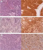 a) Classic medulloblastoma b) nodular medulloblastoma c) anaplastic medulloblastoma