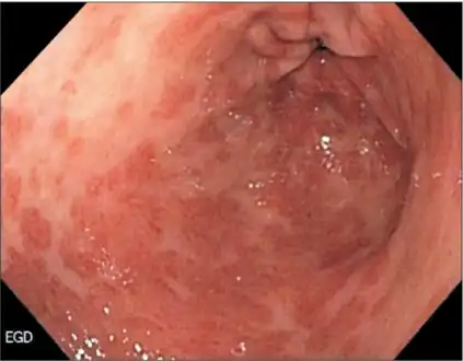 Esophagogastroduodenoscopy showing linitis plastica (and multiple gastric erosions)