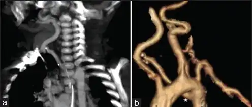 CT shows aberrant right subclavian artery