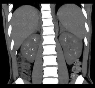 Non-contrast coronal CT  depicts nephrocalcinosis.