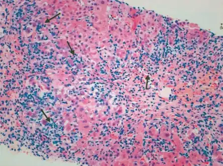 Portal and periportal inflammatory infiltrate- interface hepatitis (piecemeal necrosis) arrow(s)