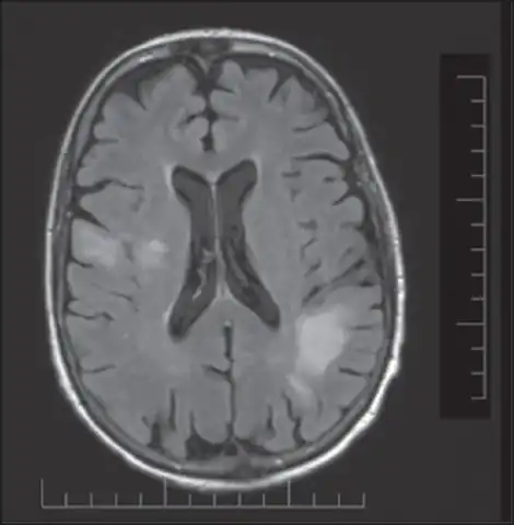 High signal intensity lesion of white matter of  dorsal right frontal lobe/right frontal operculum
