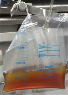 Acute intermittent porphyria-High coloured urine turned reddish brown on standing