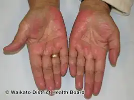 Palmar erythema