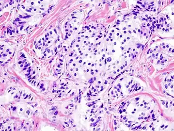 Pancreatic insulinoma