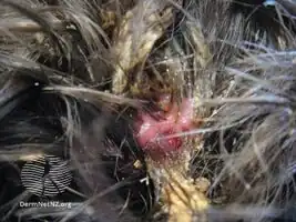 Perifolliculitis capitis abscedens et suffodiens