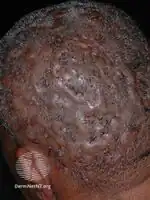 Perifolliculitis capitis abscedens et suffodiens