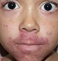 Periroal dermatitis